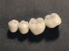 Zirconium dioxide full porcelain crown